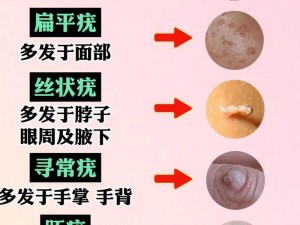 真实图片带你了解男性 HPV 感染的症状和危害