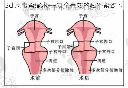 3d 束带紧缩术——安全有效的私密紧致术