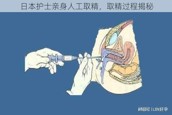 日本护士亲身人工取精，取精过程揭秘